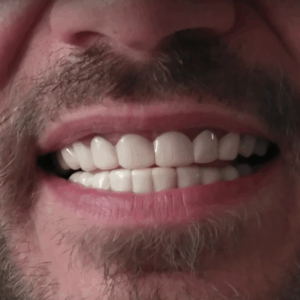 Snap On Veneer Reviews | Shiny Smile Veneers